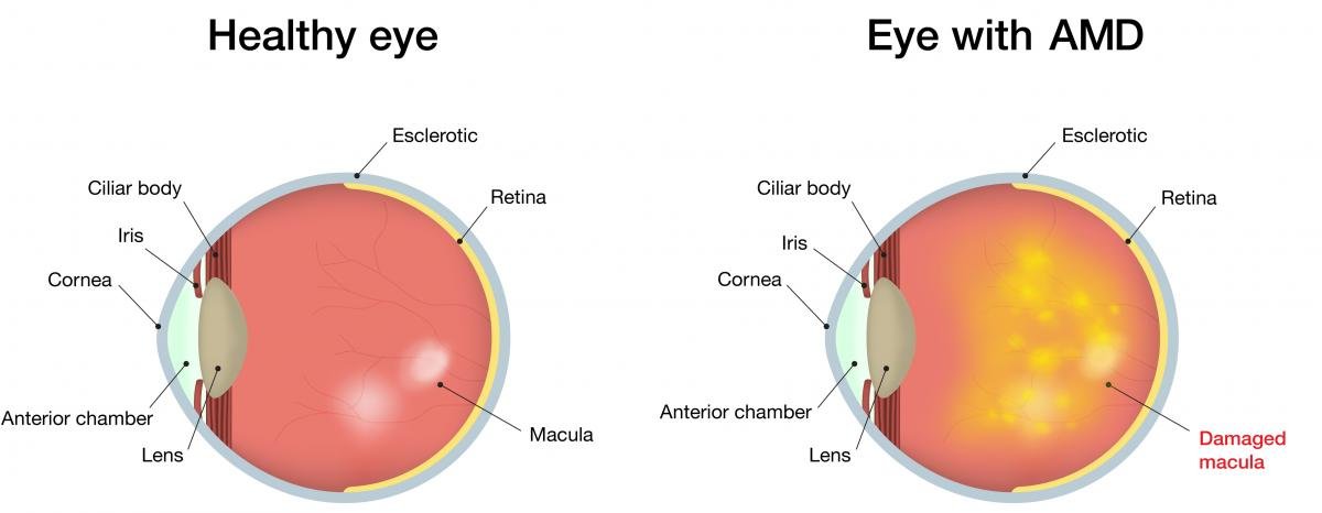 Cataract